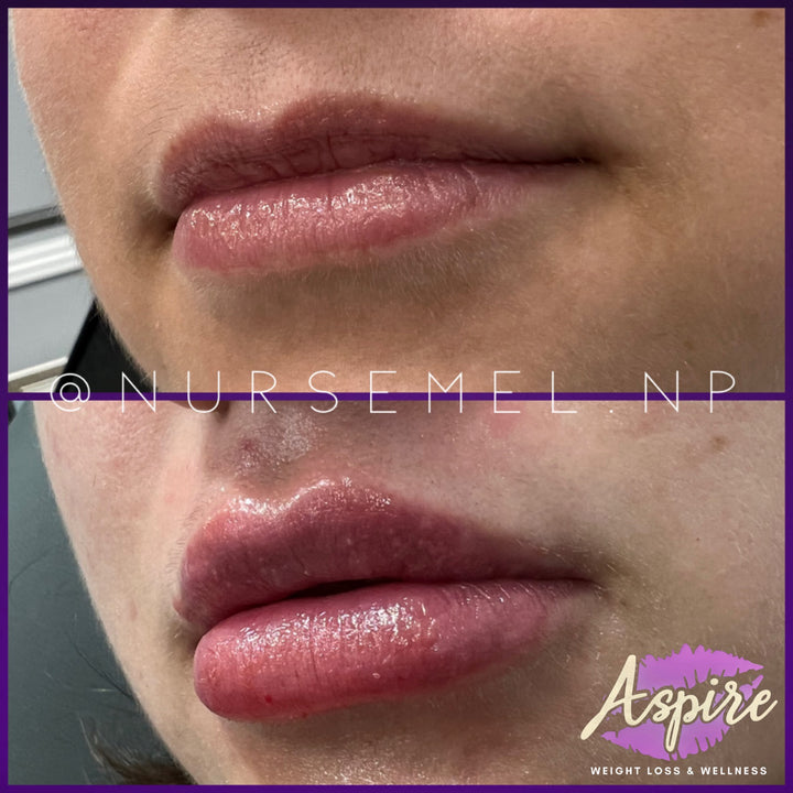 VIP Lip Filler Membership