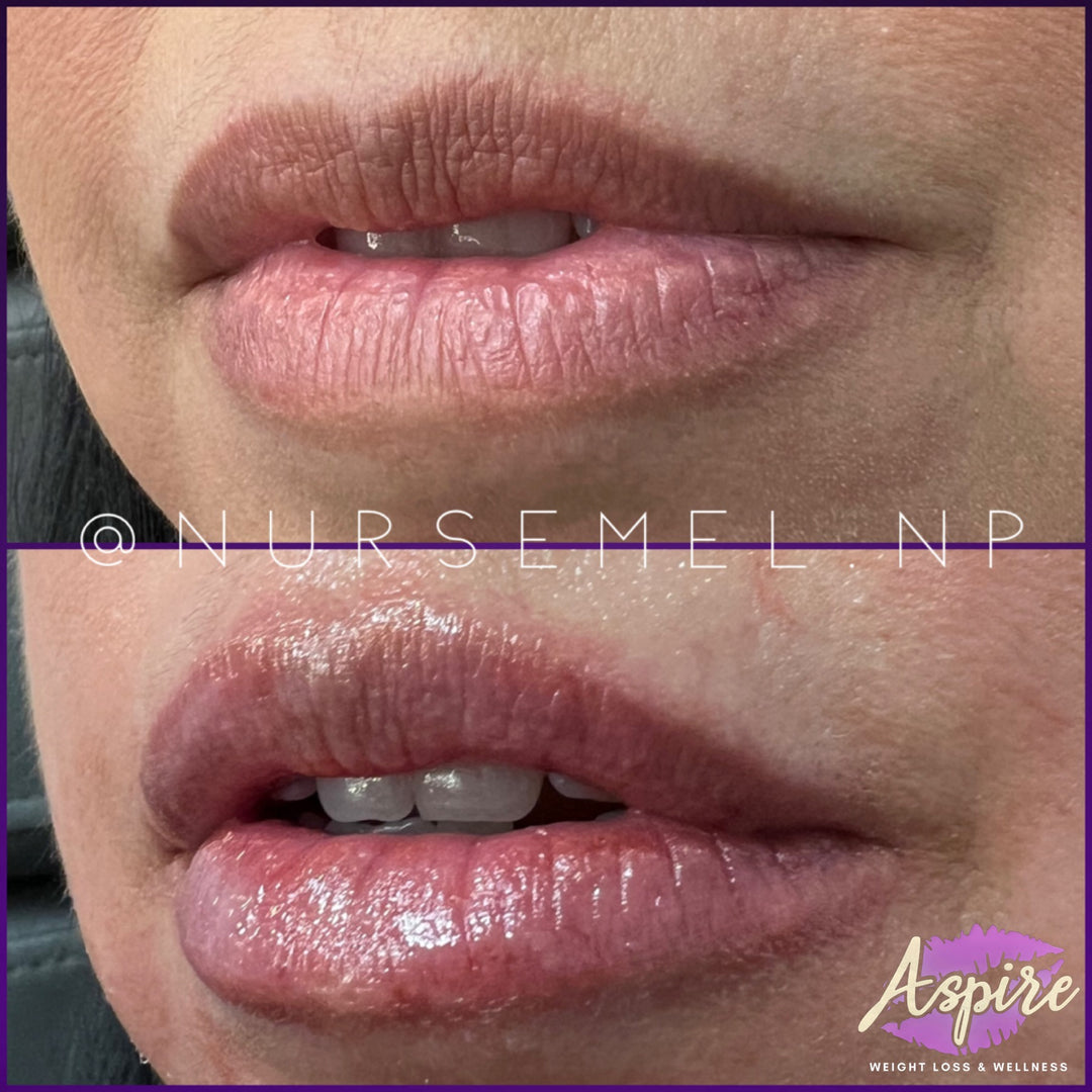 VIP Lip Filler Membership