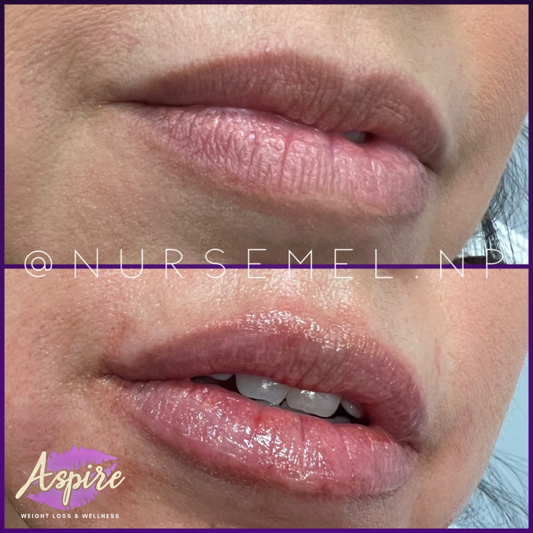 VIP Lip Filler Membership