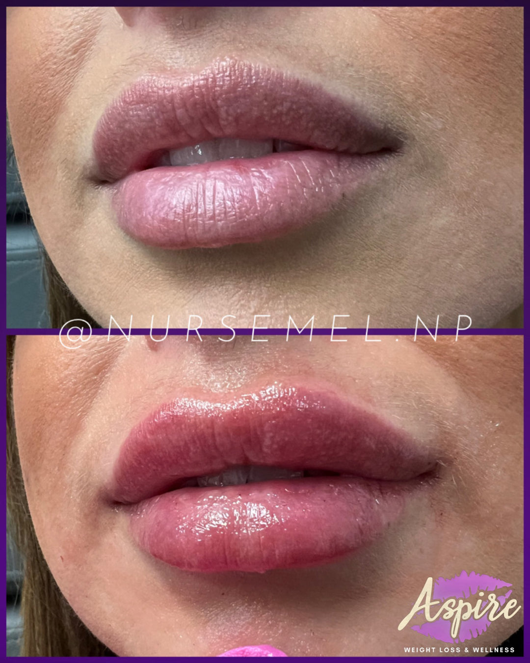 VIP Lip Filler Membership
