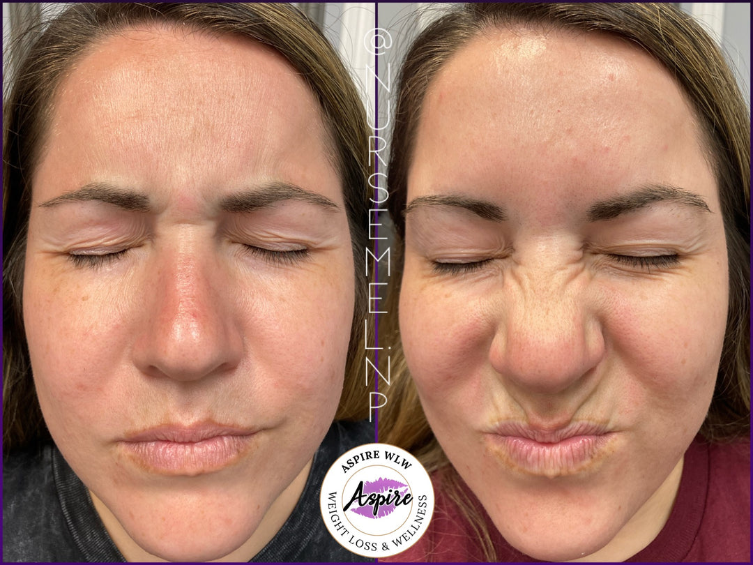 VIP Botox Membership