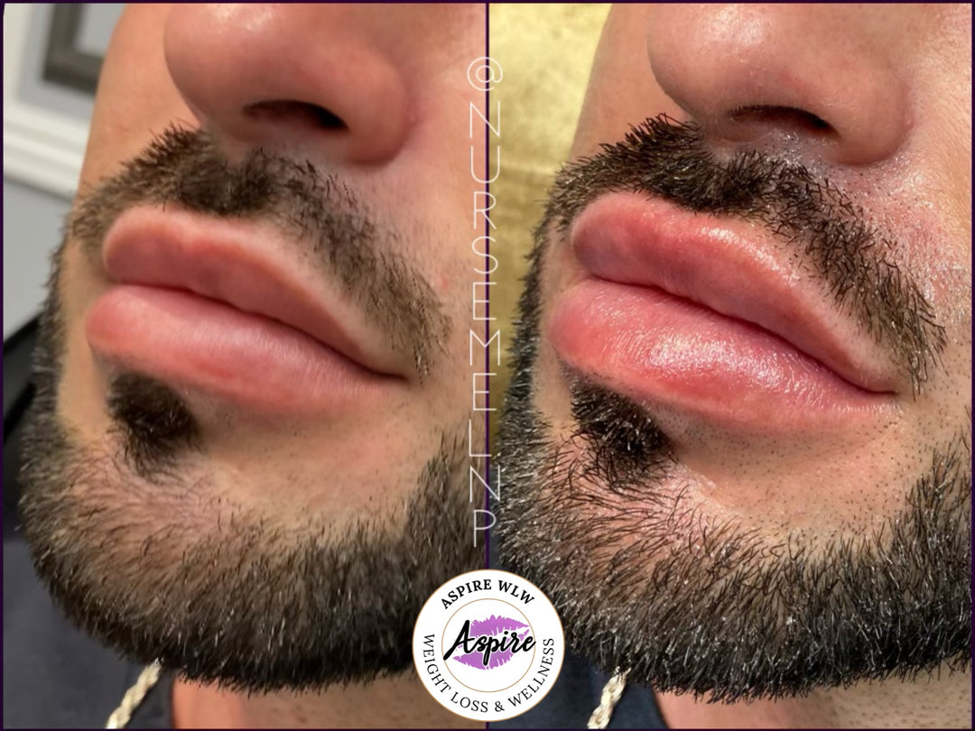 VIP Lip Filler Membership