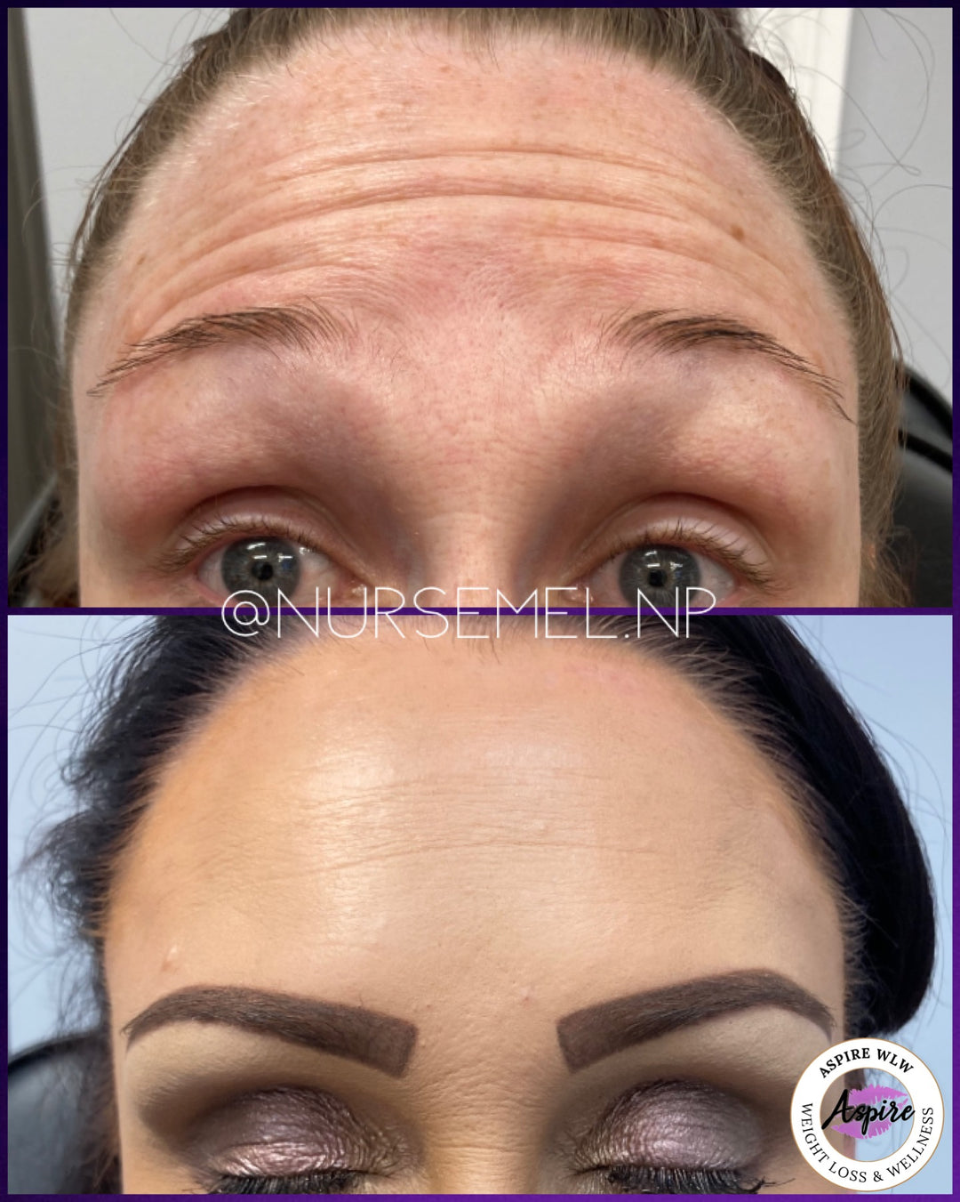 VIP Botox Membership