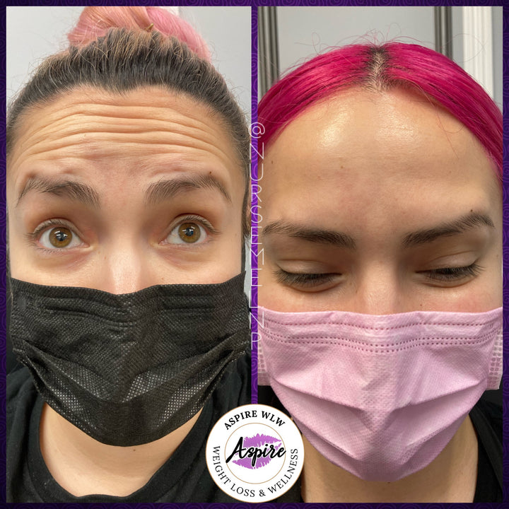 VIP Botox Membership