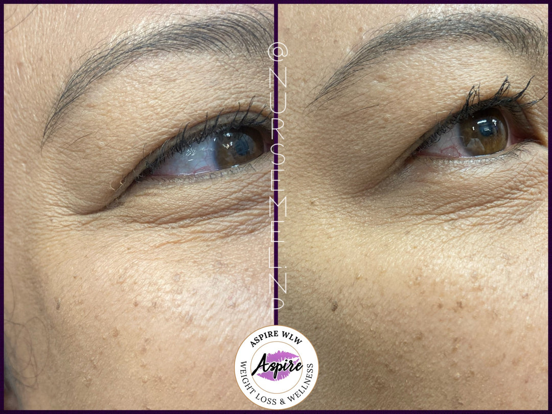 VIP Botox Membership