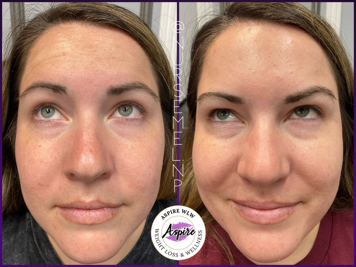 VIP Botox Membership