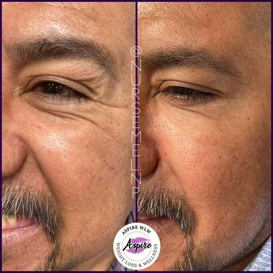 VIP Botox Membership