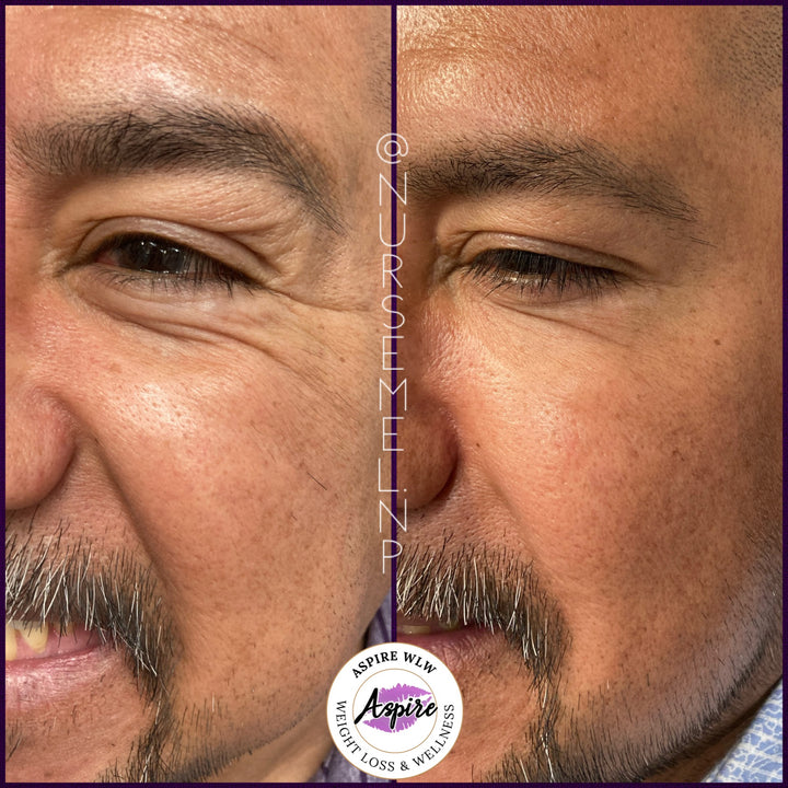 VIP Botox Membership