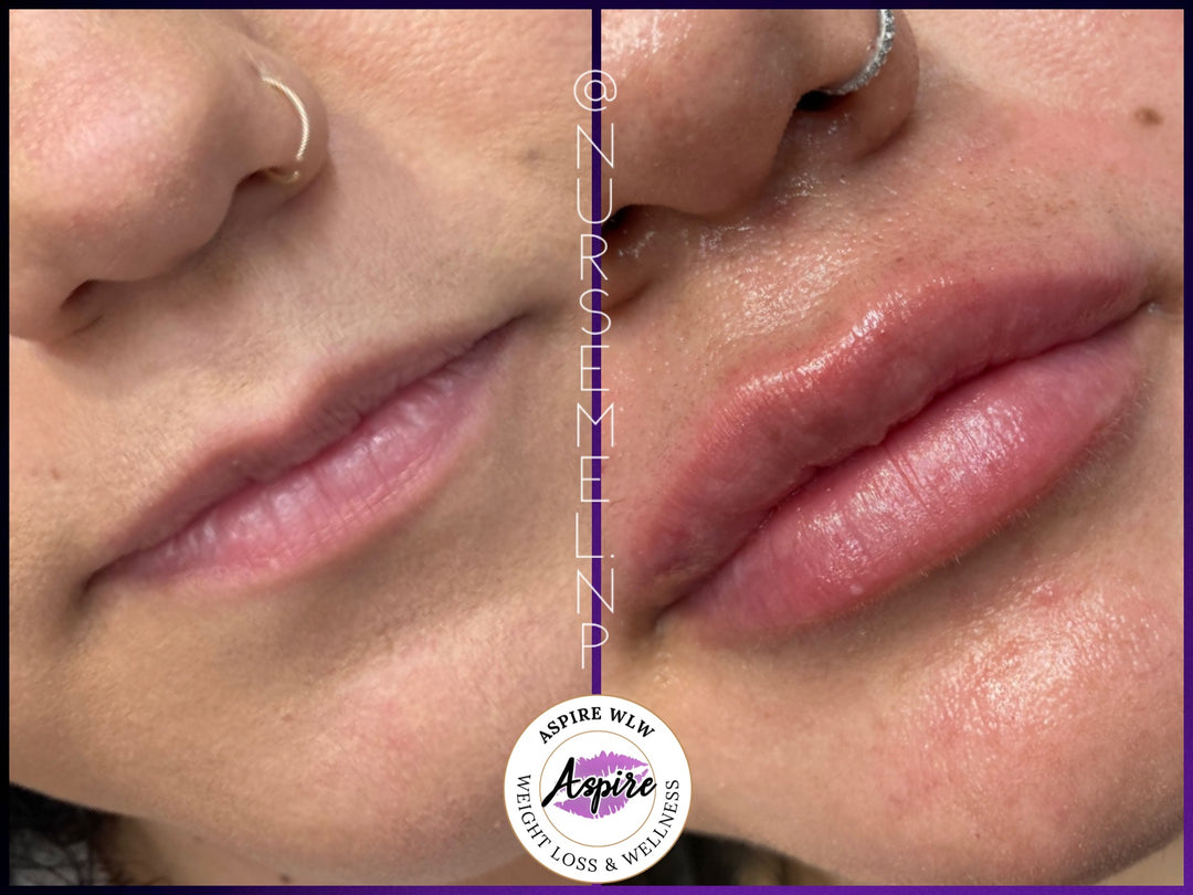 VIP Lip Filler Membership