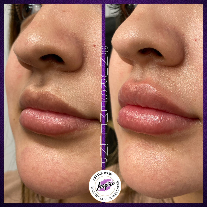 VIP Lip Filler Membership