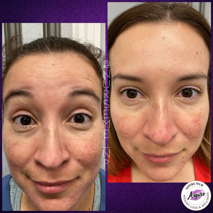 VIP Botox Membership